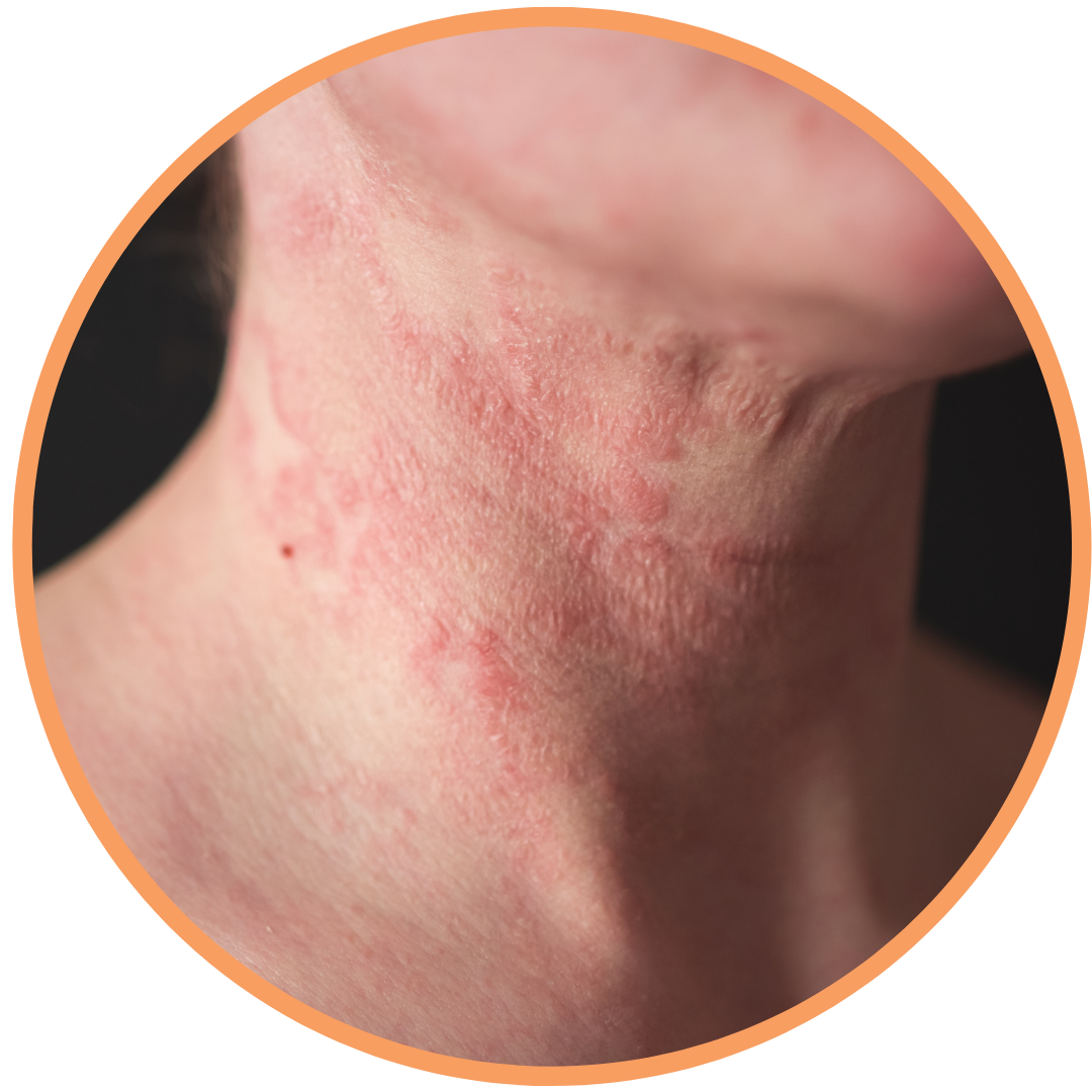 Neurodermitis: so kann deine Haut wieder erstrahlen